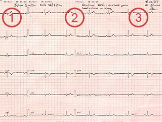 12 lead ECG - closeup