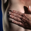 Mastectomy