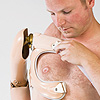 Amputation