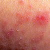 Dermatological issues