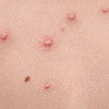 Infectious Diseases